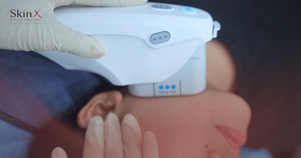 Ultherapy và HIFU khác nhau thế nào? Vì sao giá chênh nhau nhiều lần